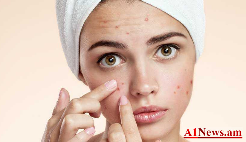 acne_e8BA-.jpg