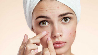 acne_e8BA-.jpg