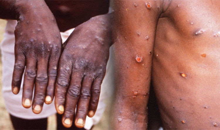 monkeypox-1-1-1_PN5Mb.jpg