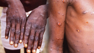 monkeypox-1-1-1_PN5Mb.jpg